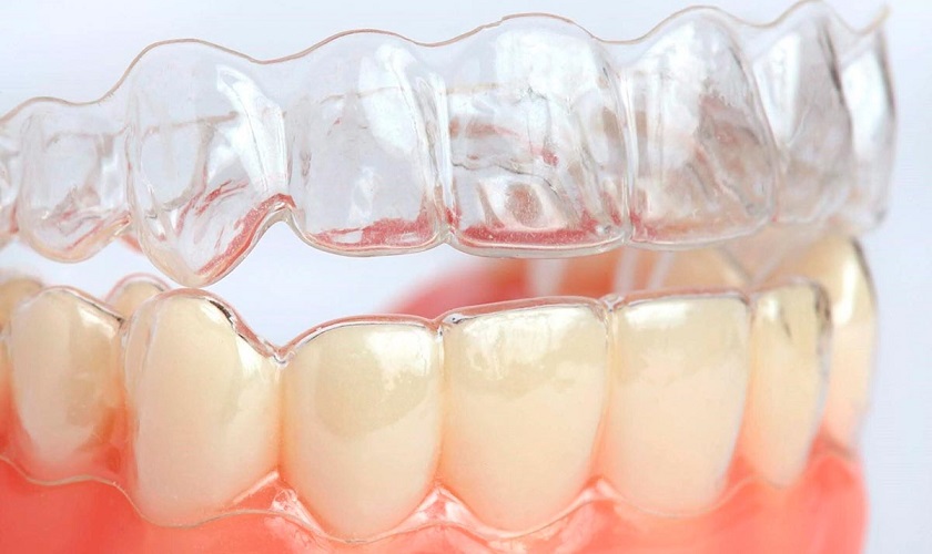 In bản vẽ mô phỏng niềng răng 3D