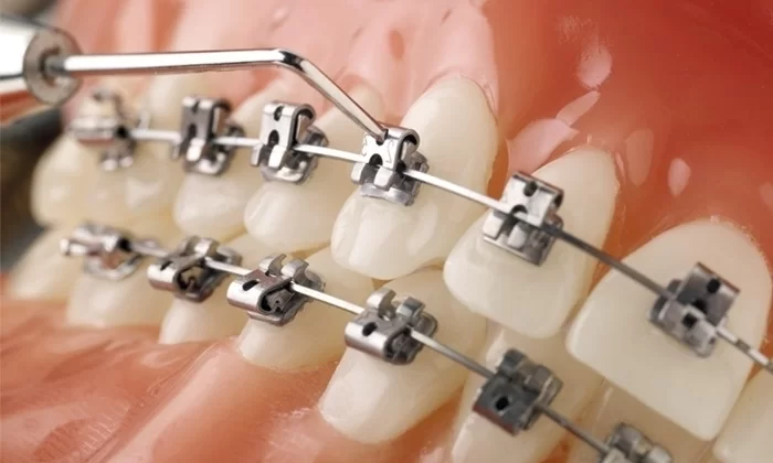 Khí cụ chỉnh nha cố định