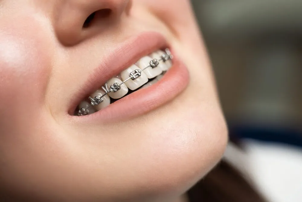 Thực hành phát âm và luyện nói trong quá trình niềng răng