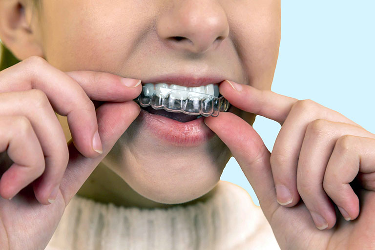 Lựa chọn phương pháp niềng răng Invisalign