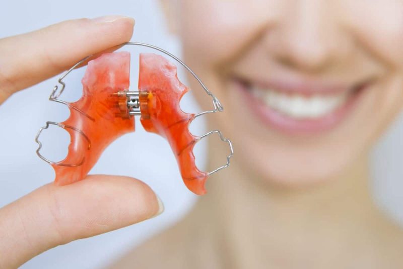 Khí cụ chỉnh nha tháo lắp