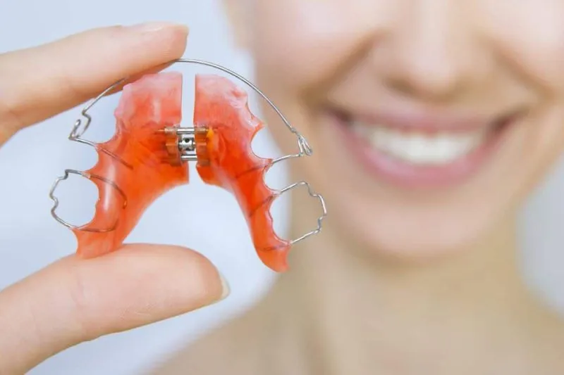 Khí cụ chỉnh nha tháo lắp