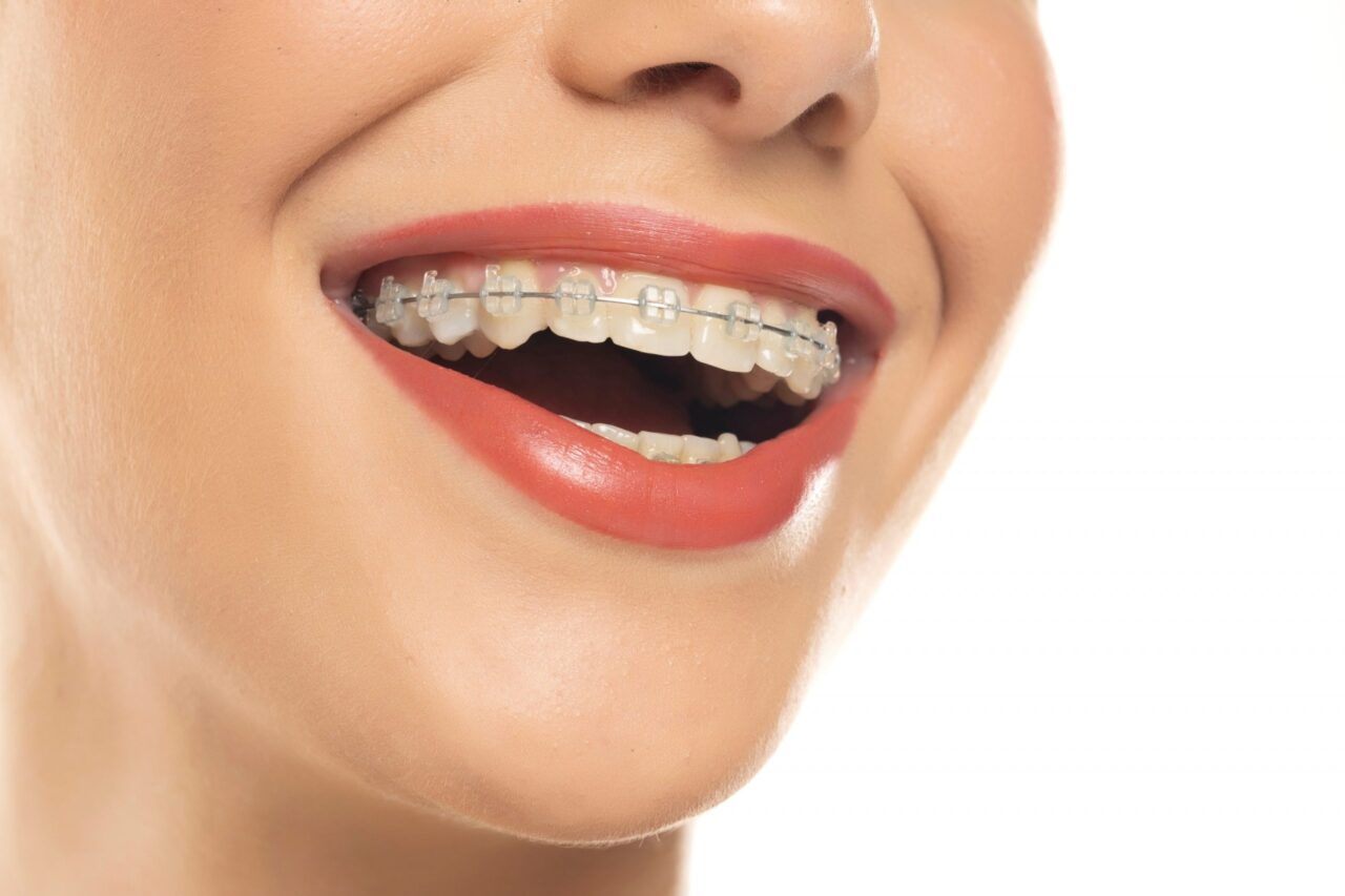 Ảnh hưởng tạm thời trong giai đoạn đầu niềng răng