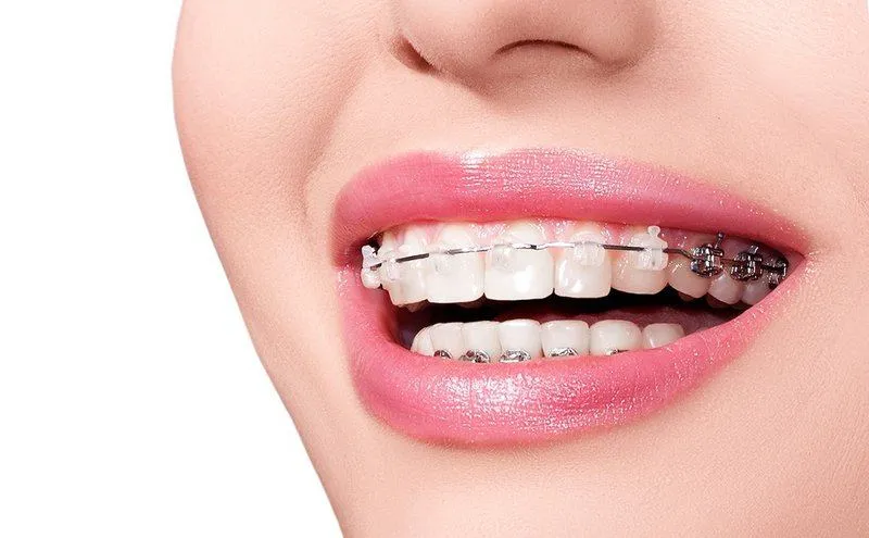Niềng răng có ảnh hưởng đến phát âm không?