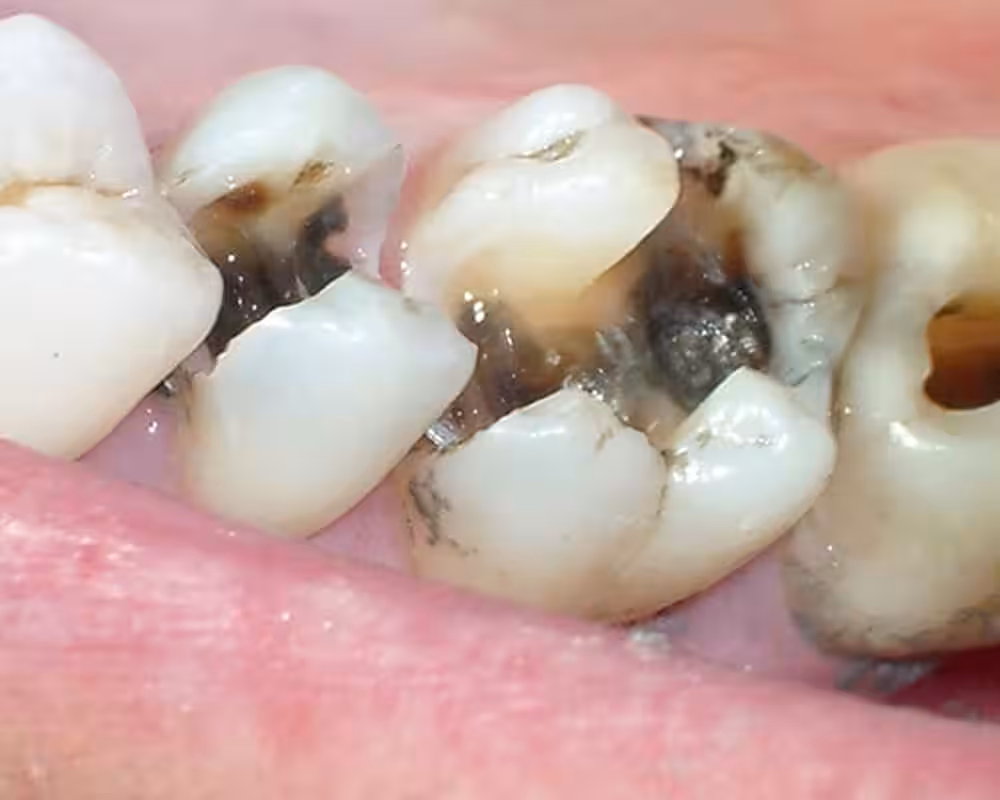 Sâu răng làm lộ ngà răng gây ra việc ăn đồ ngọt bị ê buốt răng