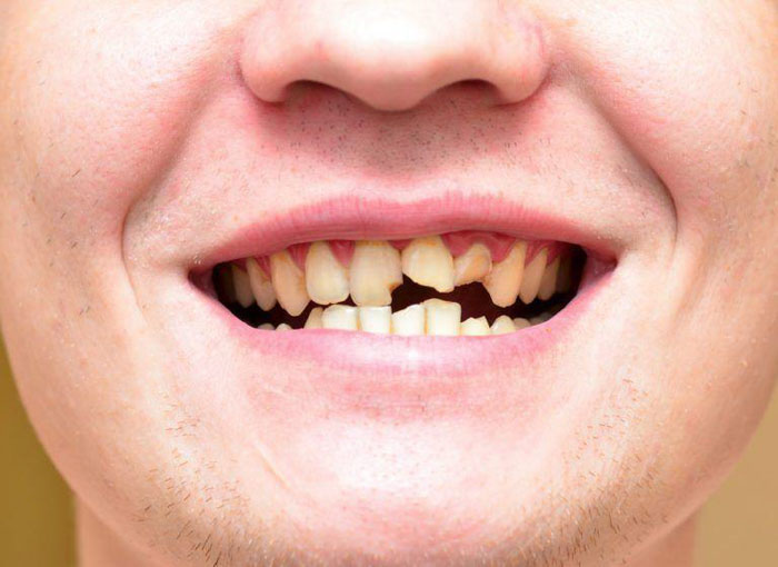 Răng bị sứt mẻ hoặc gãy vỡ do chấn thương, tai nạn