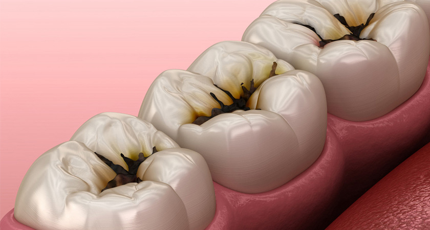 Thực sự sâu răng có bị sốt không?
