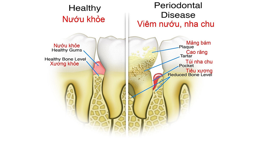 Nguy cơ viêm tủy, áp xe răng và nhiễm trùng máu