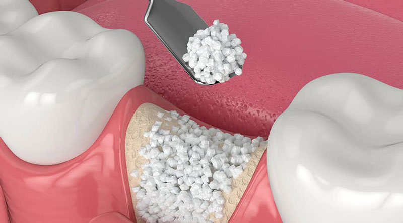 Ghép xương nhân tạo (Alloplastic graft)