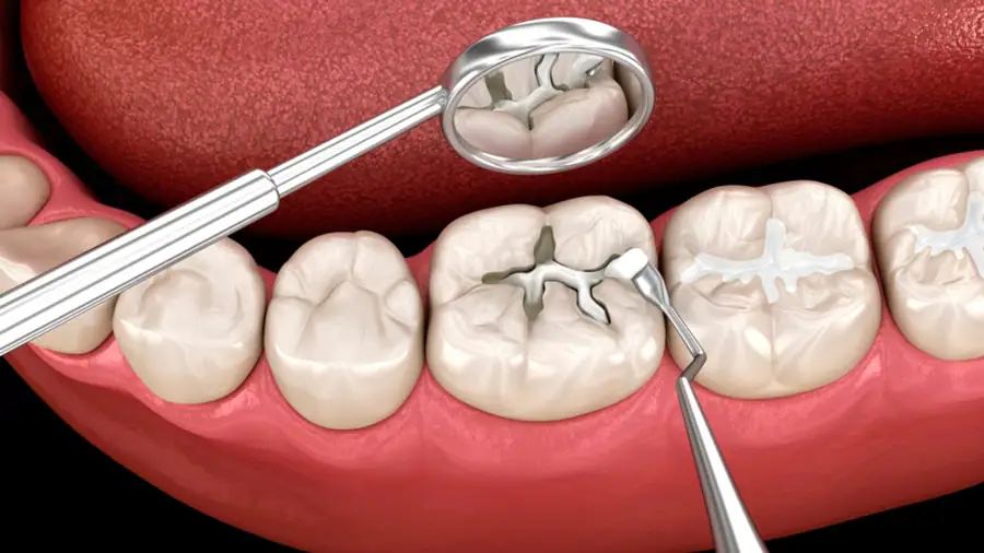 Kích ứng với thành phần vật liệu trám