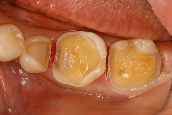 Lớp trám không khít sát hoặc bị bong hở