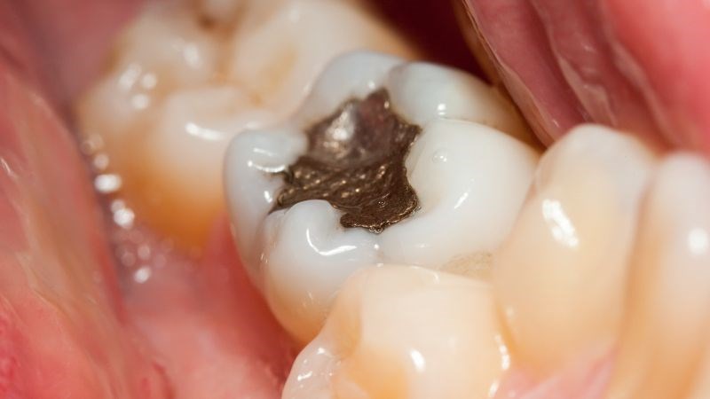 Quy trình trám răng không đảm bảo