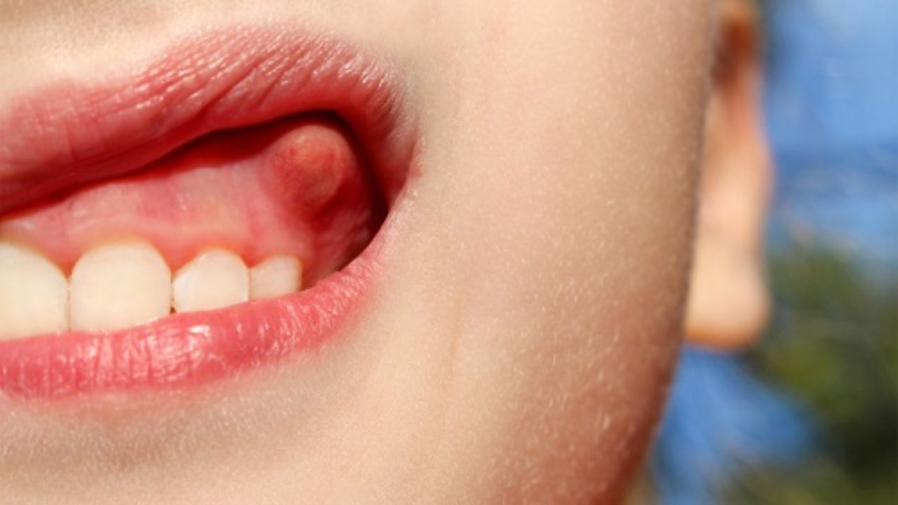 Viêm lợi là gì?