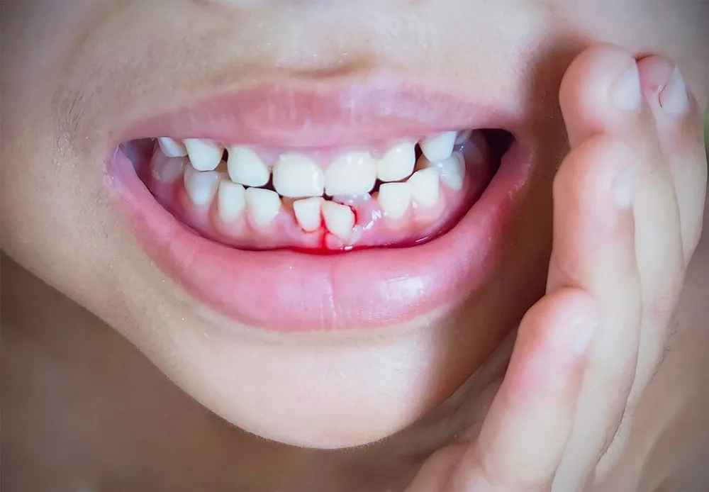 Dấu hiệu nhận biết bé 2 tuổi bị viêm lợi chảy máu chân răng