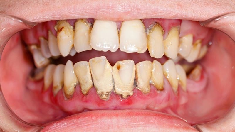 Viêm nha chu ở giai đoạn nghiêm trọng