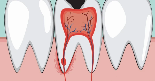 Viêm tủy, áp xe răng, ảnh hưởng đến răng vĩnh viễn