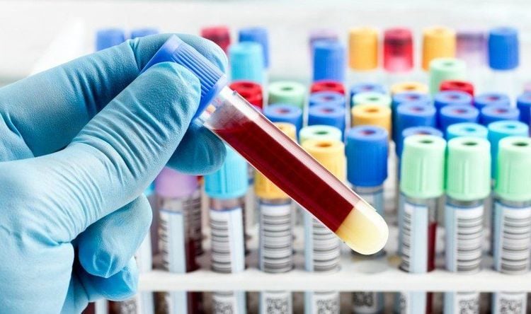 Trường hợp không có cần nhịn ăn khi xét nghiệm máu nhổ răng