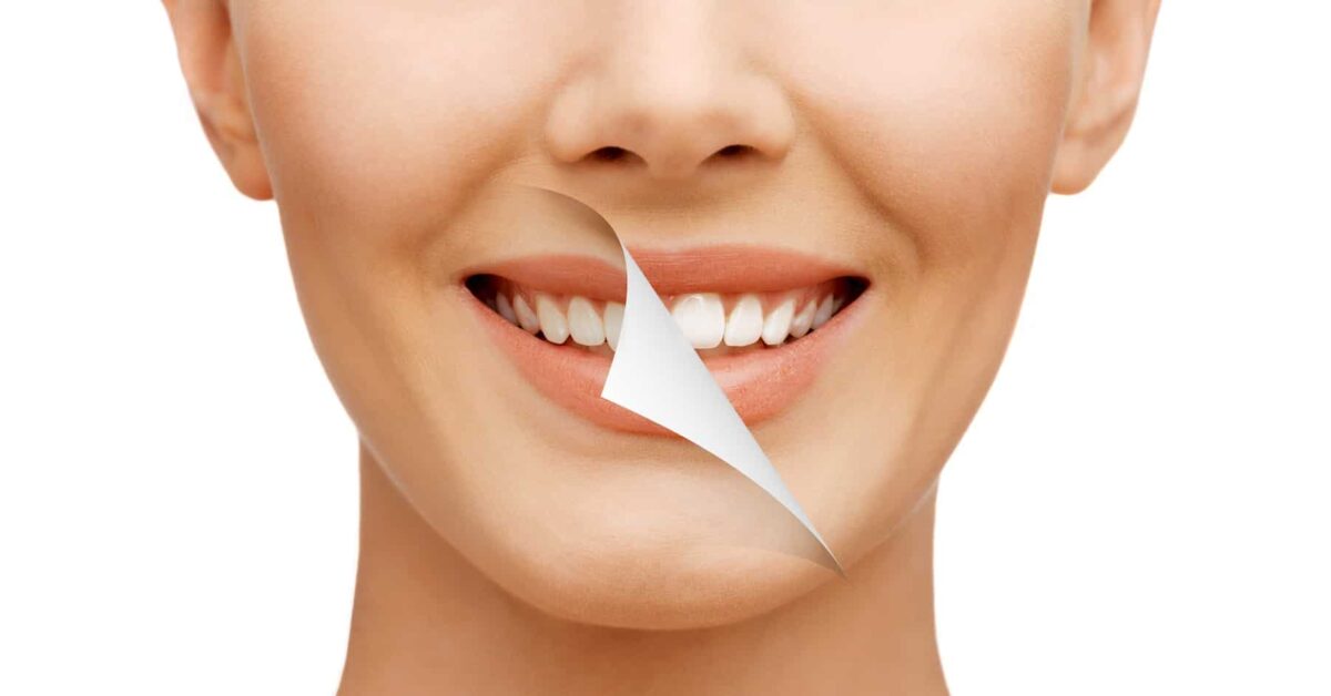 Cách làm trắng răng tại nhà an toàn và hiệu quả