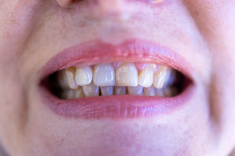 Cấy implant bao lâu thì hoàn tất? Giải đáp chi tiết từng giai đoạn