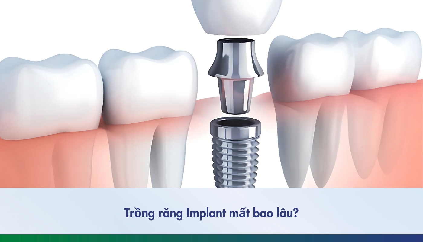 Cấy implant bao lâu thì hoàn tất? Giải đáp chi tiết từng giai đoạn