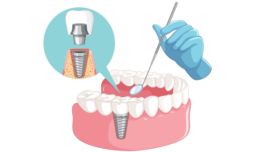 Những yếu tố ảnh hưởng đến kết quả cấy ghép Implant