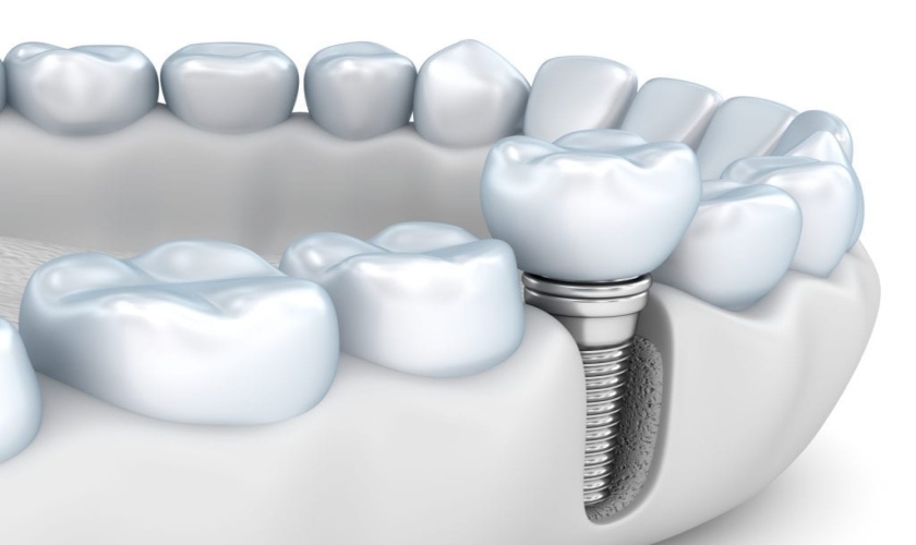 Cấy implant bao lâu thì hoàn tất? Giải đáp chi tiết từng giai đoạn