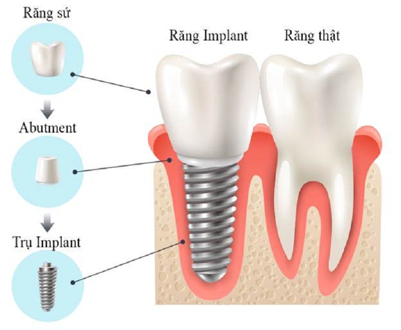 Quy trình trồng răng Implant an toàn, hiện đại tại Cường Nhân