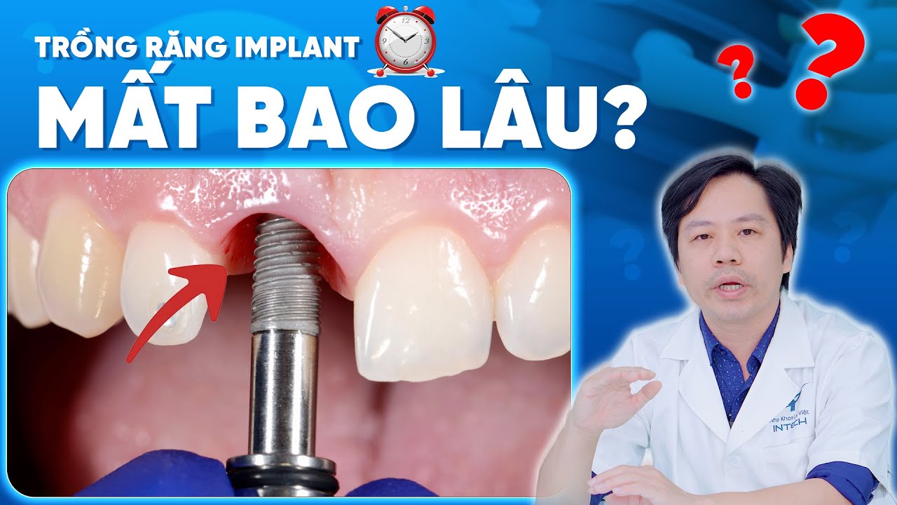 Cấy implant bao lâu thì hoàn tất? Giải đáp chi tiết từng giai đoạn