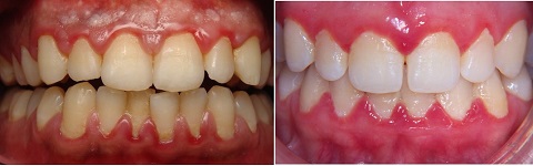 Chảy máu chân răng là bệnh gì? Nguyên nhân và cách xử lý