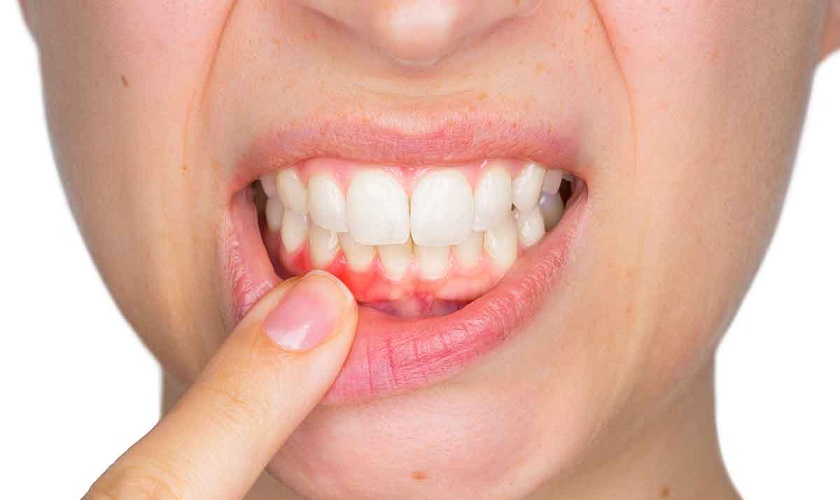 Bệnh nha chu có chữa được không? Các phương pháp điều trị