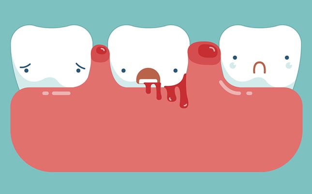Chảy máu chân răng có thể là tín hiệu cảnh báo những căn bệnh nào? - Nha khoa Phạm Hùng