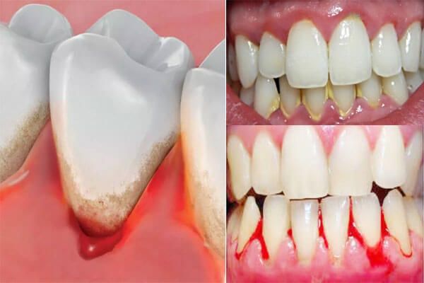 Chảy máu chân răng là bệnh gì? Nguyên nhân và cách xử lý