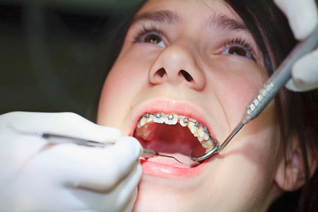 Hướng dẫn chi tiết niềng răng cho trẻ em hiệu quả nhất