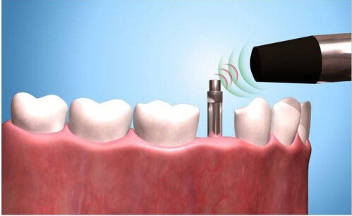 Implant tức thì là gì? Phương pháp trồng răng nhanh, tiện lợi