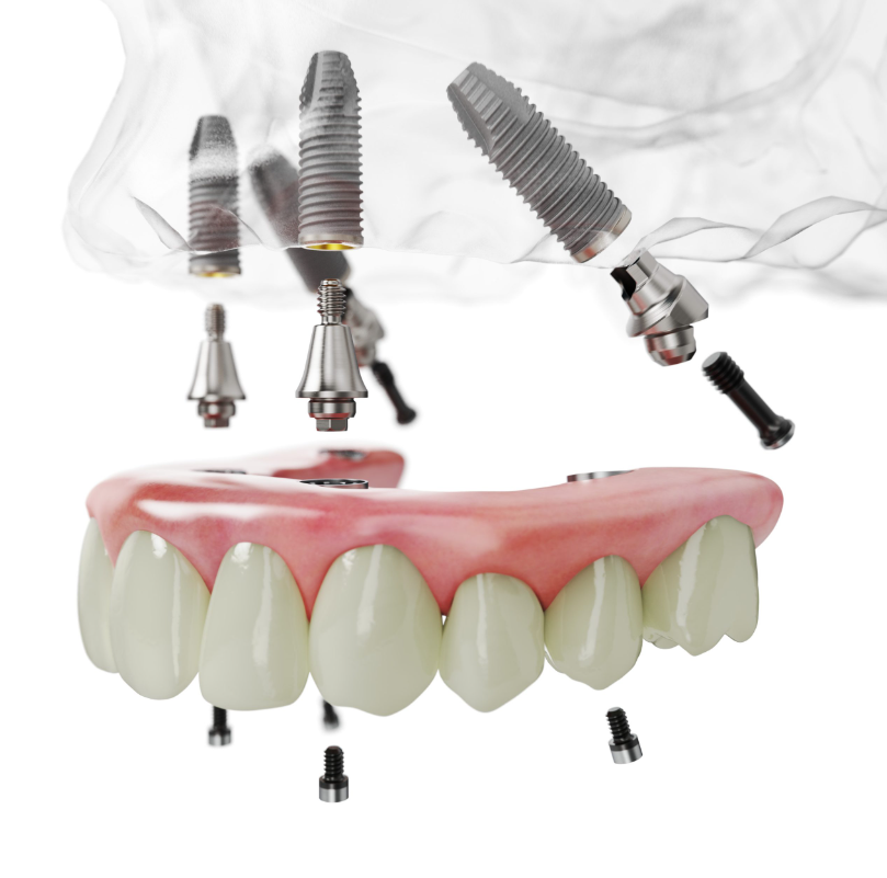 Implant tức thì là gì? Phương pháp trồng răng nhanh, tiện lợi