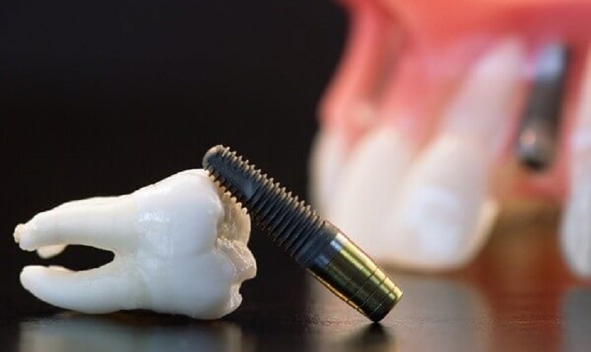 Implant tức thì là gì? Phương pháp trồng răng nhanh, tiện lợi
