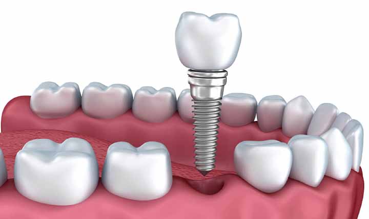 Cấy ghép Implant tức thì: Giải pháp hiện đại và toàn diện cho bệnh nhân mất răng