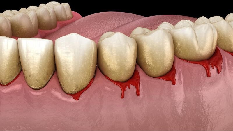 Lấy cao răng có hiệu quả không? Giải đáp từ chuyên gia nha khoa