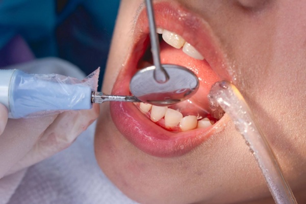 Tác hại của việc lấy cao răng sai cách và làm sao phòng ngừa?