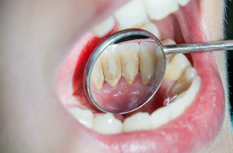 Nên đi khám răng bao lâu 1 lần? Lịch khám răng định kỳ chuẩn cho mọi độ tuổi