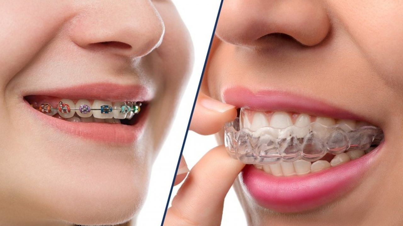 Chi Phí Niềng Răng Trong Suốt Invisalign Giá Bao Nhiêu【2024】