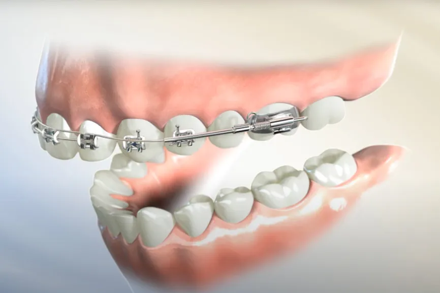 Các phương pháp niềng răng 1 hàm phổ biến hiện nay