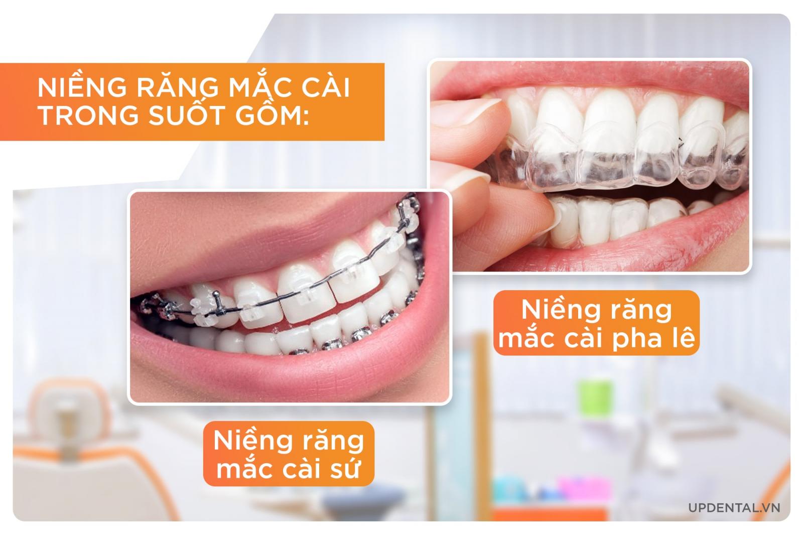 Niềng răng mắc cài trong suốt giá bao nhiêu? Có tốt không? | Up Dental