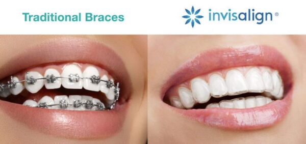So sánh niềng răng mắc cài và niềng răng trong suốt - Nên lựa chọn loại nào