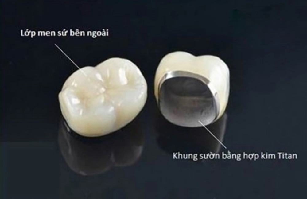 So sánh răng sứ Zirconia và răng sứ kim loại - Đâu là lựa chọn tốt?