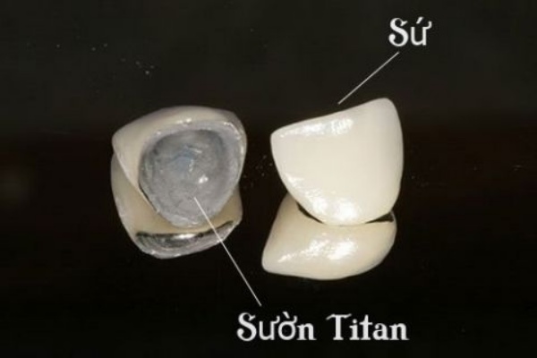 Răng sứ Titan là gì? Có tốt không, độ bền bao lâu?