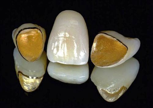 boc-rang-su-bao-nhieu-tien-1-rang-2
