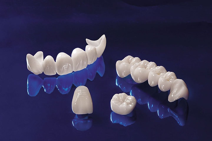 Bọc răng sứ titan có tốt không ? Ưu nhược điểm răng sứ titan