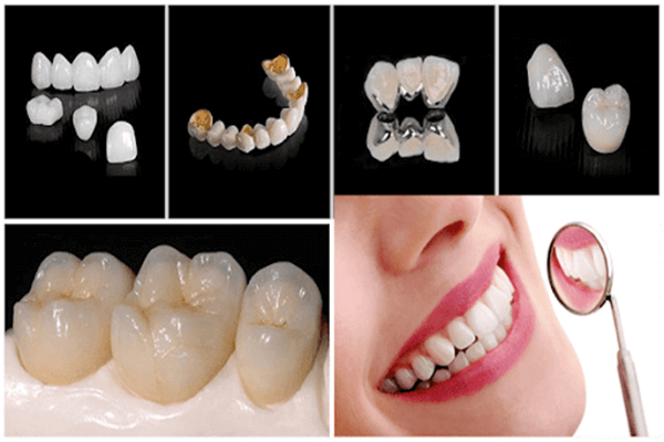 Răng sứ Titan sử dụng được bao lâu phụ thuộc yếu tố nào?