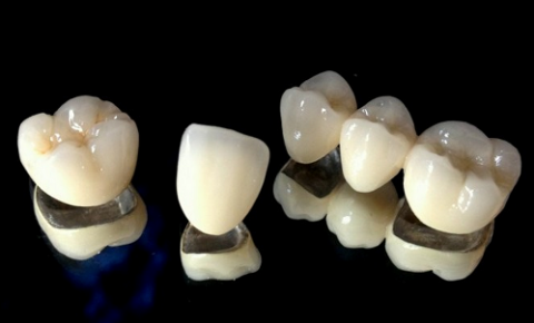 Giá răng sứ Titan bao nhiêu tiền? Cập nhật bảng giá mới nhất